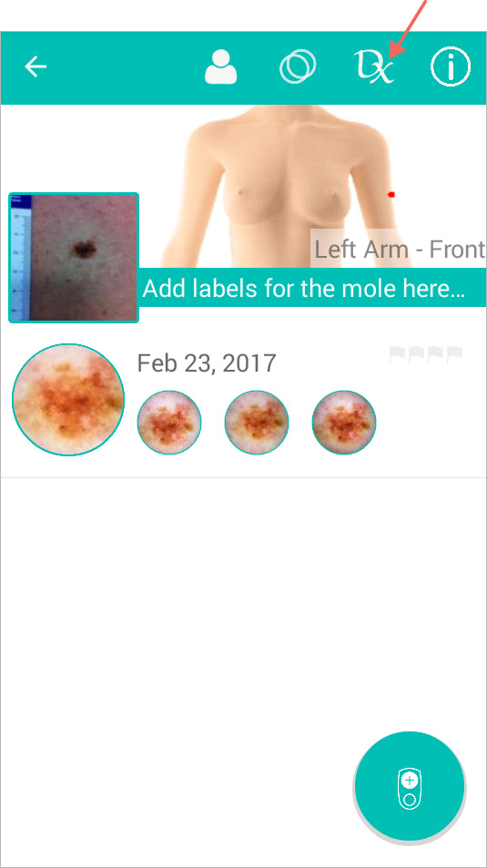 patient_moles.jpg